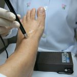 CNAS: Peste 60% din persoanele cu diabet dezvolta neuropatie diabetica