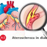 Colesterolul „bun” poate combate ateroscleroza in diabet