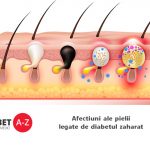 Afectiuni ale pielii legate de diabetul zaharat