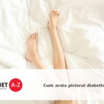 Cum arata piciorul diabetic?